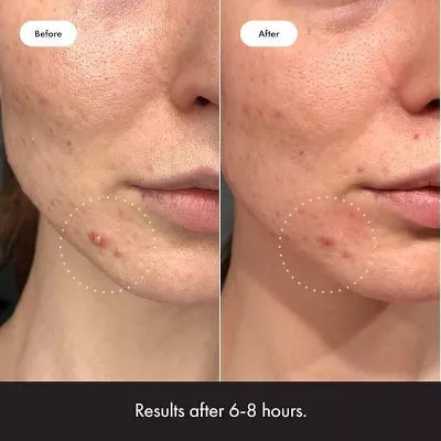 Hero Cosmetics Mighty Patch Invisible + Acne Pimple Patches - 24ct